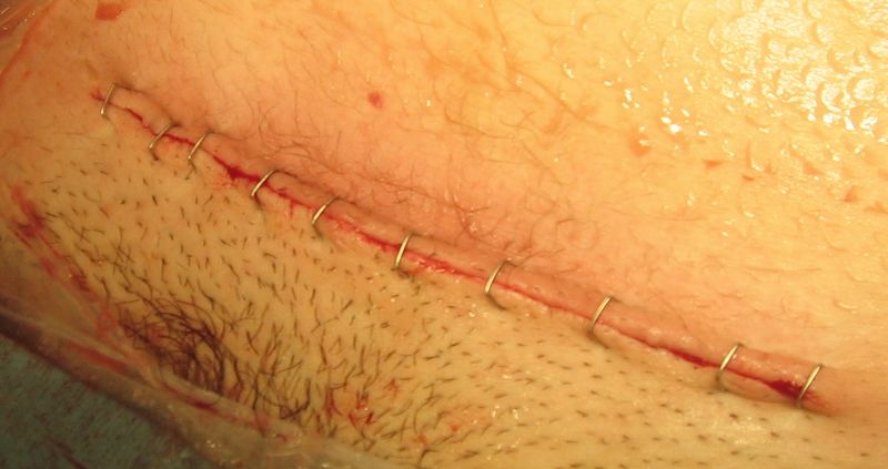 ملف:C-sec suture.jpg