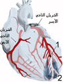 Diagram of a myocardial infarction