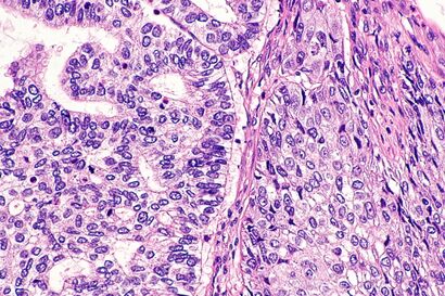 Adenosquamous carcinoma of lung -- high mag.jpg