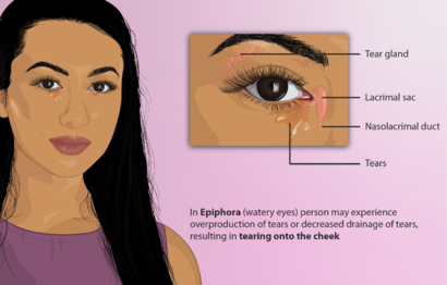 Depiction of a person with Watery Eyes (Epiphora).png