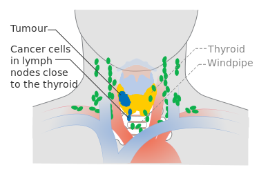 ملف:Diagram showing stage N1a thyroid cancer CRUK 242.svg