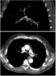 CT pulmonary angiography showing a "saddle embolus" at the bifurcation of the main pulmonary artery and thrombus burden in the lobar arteries on both sides.