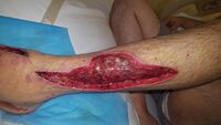 Wound after aggressive acute debridement of NF