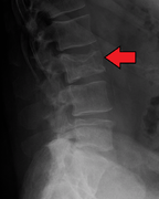 Pathological fracture of the lumbar spine due to multiple myeloma