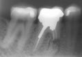 Molar 47 (left), molar 46 and premolar 45(right)