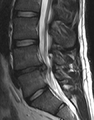 MRI scan of large herniation (on the right) of the disc between the L4-L5 vertebrae.