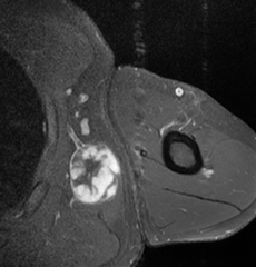 MRI of myxoid liposarcoma of high grade, in left axillary region of 40 year old man. Highlighted by the white color. Horizontal section.