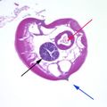 Pinworms are sometimes diagnosed incidentally by pathology. Micrograph of male pinworm in cross section. Alae (blue arrow), intestine (red arrow) and testis (black arrow). H&E stain.