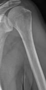 Same humerus before, with just subtle lesions
