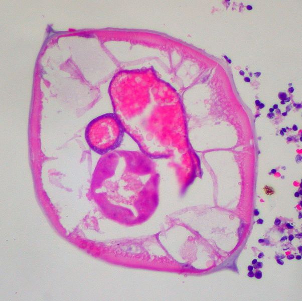 ملف:Pinworms in the Appendix (3).jpg