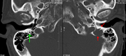 A CT of the brain revealed a lytic lesion in the left temporal bone (right side of image), and petrous temporal bones involving the mastoid segment of the facial nerve canal. Red arrows: lesion; green arrow: normal contralateral facial nerve canal. The lesions are consistent with a myeloma deposit.