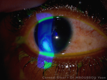Corneal Ulcer.png