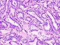 Micrograph showing that the papillae in papillary thyroid carcinoma are composed of cuboidal cells. H&E stain.