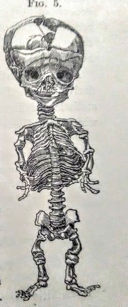 ملف:Skeleton Infant Rickets.jpeg