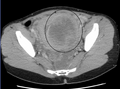 A very large (9 cm) fibroid of the uterus which is causing pelvic congestion syndrome as seen on CT