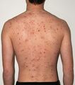 The back of a 30-year-old male after five days of the rash
