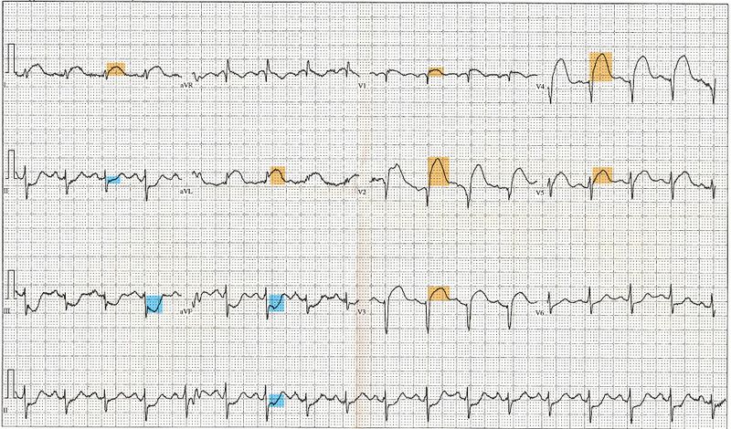 ملف:12 Lead EKG ST Elevation tracing color coded.jpg