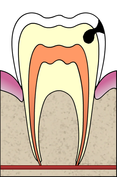 ملف:Cavities evolution 3 of 5 ArtLibre jnl.png