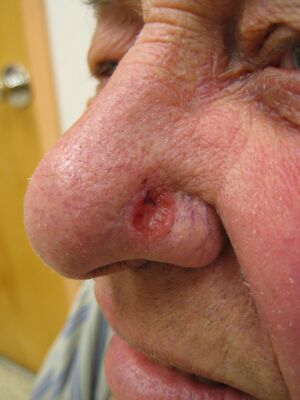 Basal cell carcinoma2.JPG