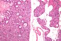 Parathyroid adenoma intermed mag.jpg