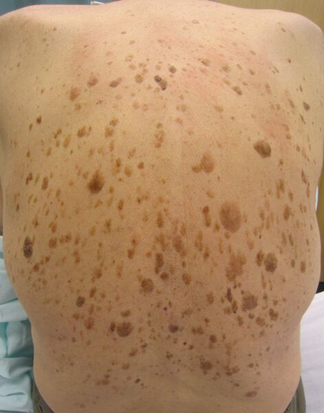 ملف:Seborrheic keratosis on human back.jpg