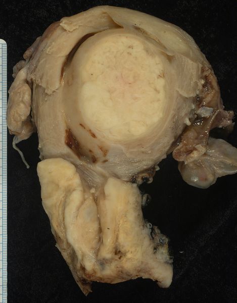 ملف:Squamous carcinoma of the cervix.jpg