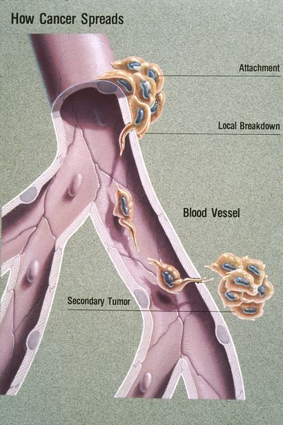 Metastasis illustration.jpg