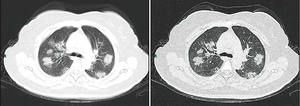 CT imaging of rapid progression stage