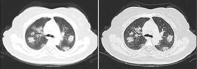 CT imaging of rapid progression stage.