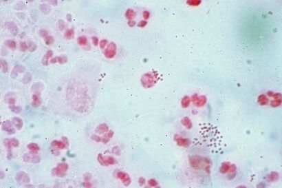 Neisseria gonorrhoea in pus - Gram stain.jpg