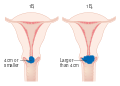 المرحلة 1B من سرطان عنق الرحم.