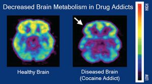تظهر صور التصوير المقطعي بالإصدار البوزيتروني الاستقلاب للدماغ لدى مدمني المخدرات مقابل الضوابط