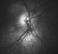 High detail picture of optic disc.