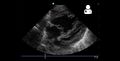 4 month old with pulmonary hypertension as seen on ultrasound[15]