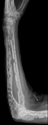 X-ray of the forearm, with lytic lesions.