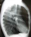 صورة أشعة سينية لصدر شخص مصاب بانتفاخ الرئة. لاحظ الصدر البرميلي والحجاب الحاجز.