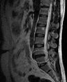 MRI Scan of lumbar disc herniation between fourth and fifth lumbar vertebral bodies.