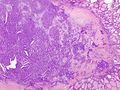 Micrograph of papillary thyroid carcinoma demonstrating prominent papillae with fibrovascular cores. H&E stain.