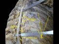 Spinal nerves. Spinal cord and vertebral canal. Deep dissection.