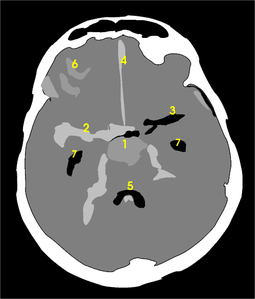 Subarachnoid hemorrhage CT map.png
