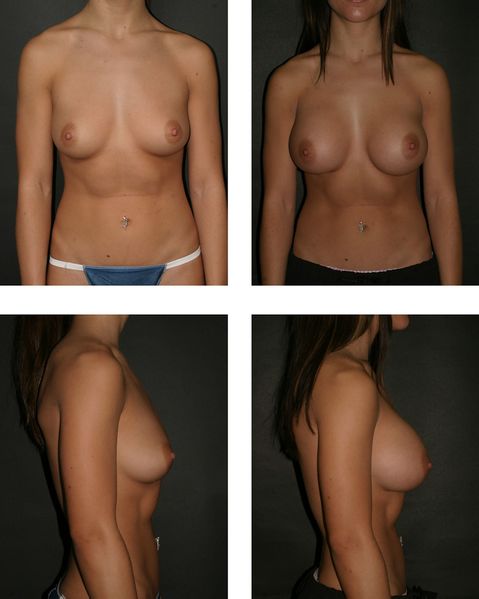 ملف:Dr. Placik Breast Augmentation.jpg