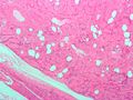 Uterine lipoleiomyoma, a type of leiomyoma. H&E stain.