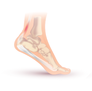 Achilles tendonitis.svg