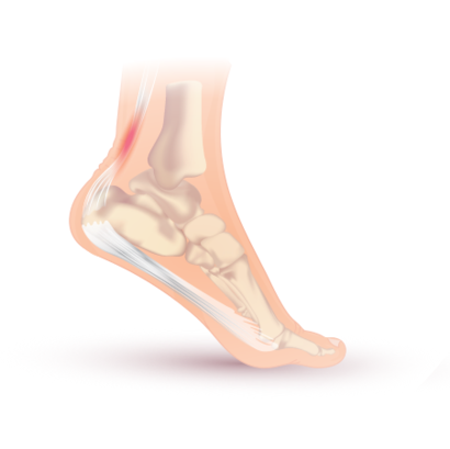 Achilles tendonitis.svg