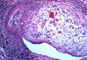 Obliterative bronchiolitis involving the terminal airways.