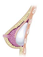 Subpectoral breast implant diagram