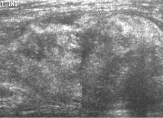 Medical ultrasonography of a liposarcoma: In this case a heterogeneous mass consisting of an upper hyperechoic portion, corresponding to lipomatous matrix, and areas of hypoechogenicity corresponding to nonlipomatous components.[5]