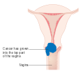 المرحلة 2A من سرطان عنق الرحم.