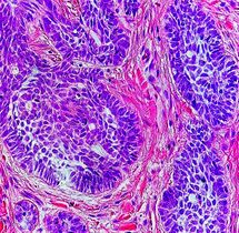 Nests: islands of cells of similar type.
