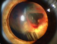 Slit lamp photograph showing retinal detachment in Von Hippel-Lindau disease EDA08.JPG